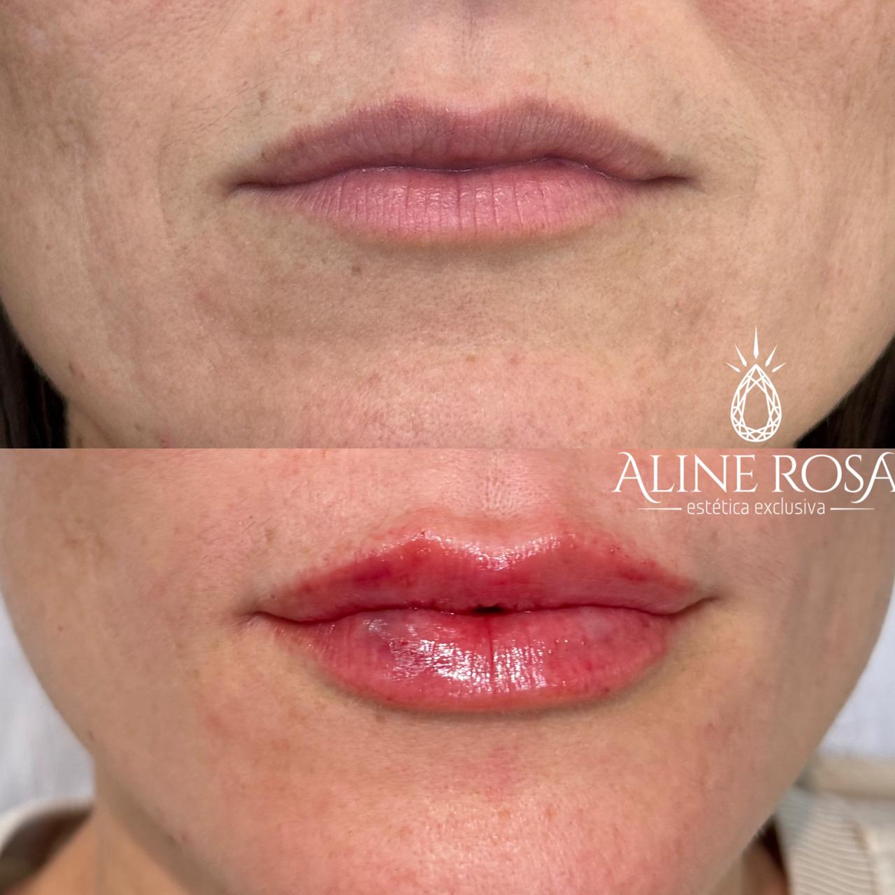 Estruturação Labial